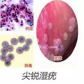 明星尖锐湿疣,揭秘尖锐湿疣背后的真相
